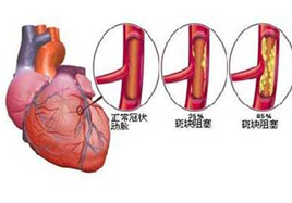 為什么冠心病在冬季高發(fā)?預(yù)防冠心病的方法補(bǔ)硒
