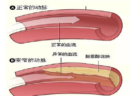 有了動(dòng)脈粥樣硬化怎么辦