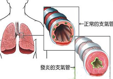 支氣管炎補(bǔ)硒