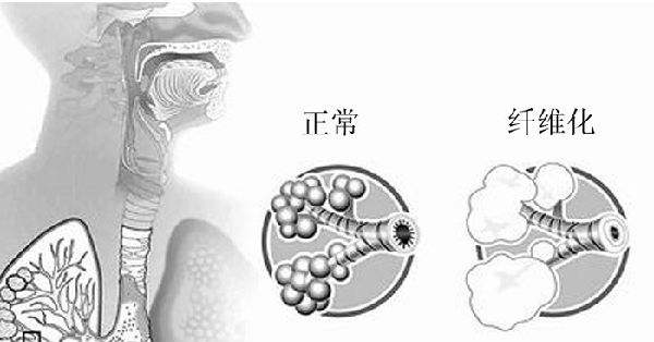 肺纖維化對比圖