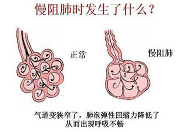 慢性阻塞性肺疾病的癥狀及預(yù)防緩解措施有哪些